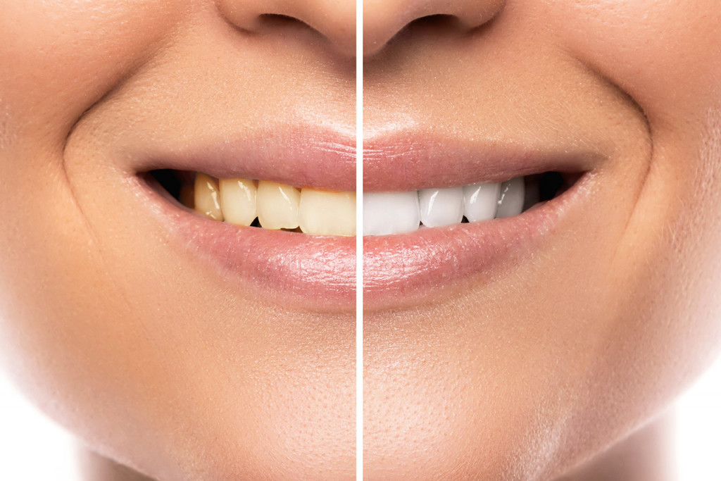 Sbiancamento dentale: risultati prima e dopo