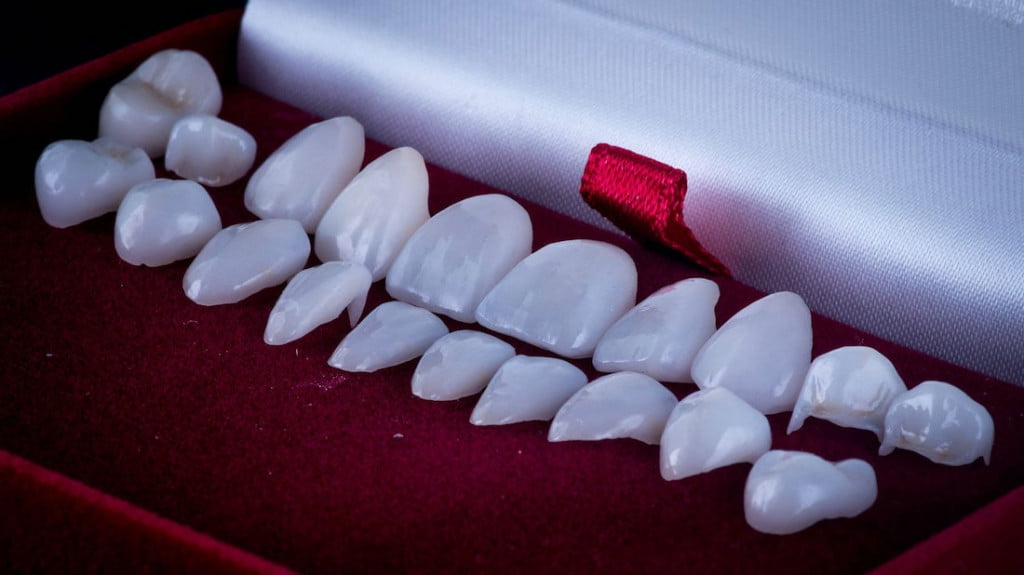 dental veneers before after