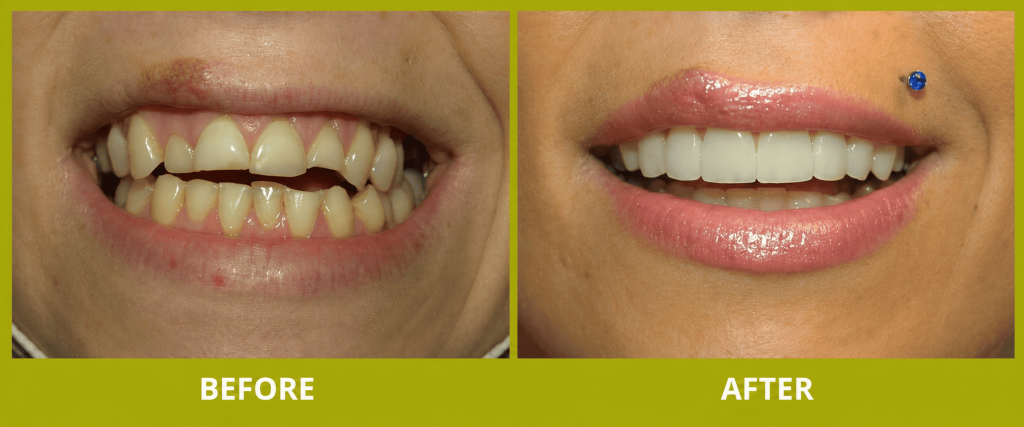 dental veneers before after