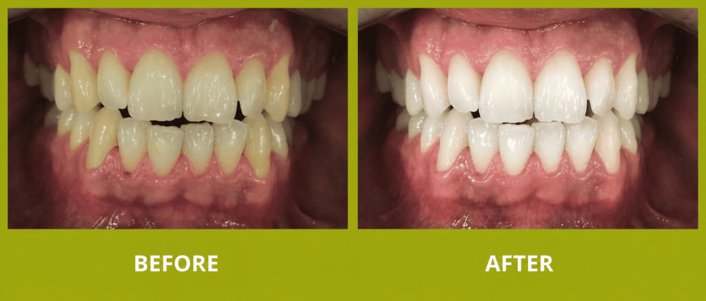 Teeth whitening before after