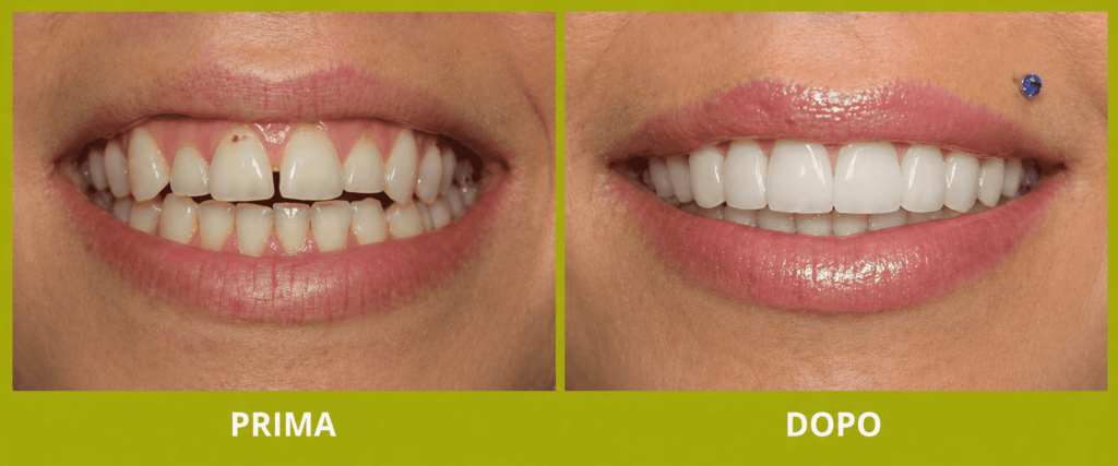 faccette dentali prima dopo