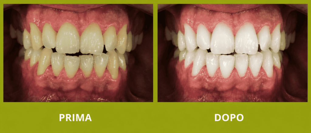 Sbiancamento dei denti prima dopo