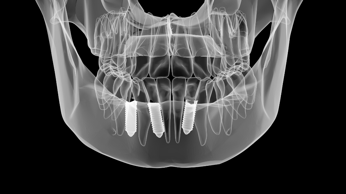 impianto - implantat - ugradnja implantata