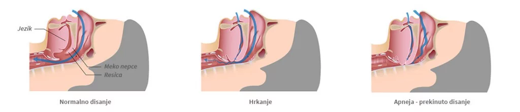Hrkanje-Apneja-prikaz