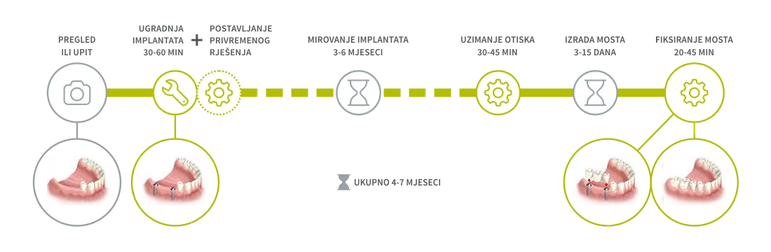 Implantologija - Nedostatak nekoliko zuba
