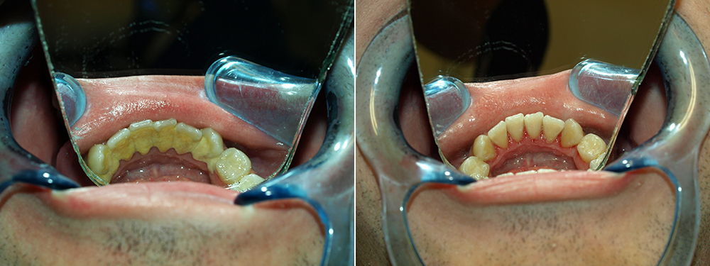 dental calculus before and after