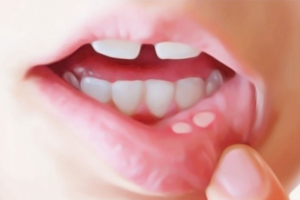 how-to-get-rid-of-canker-sores-here-are-3-simple-ways