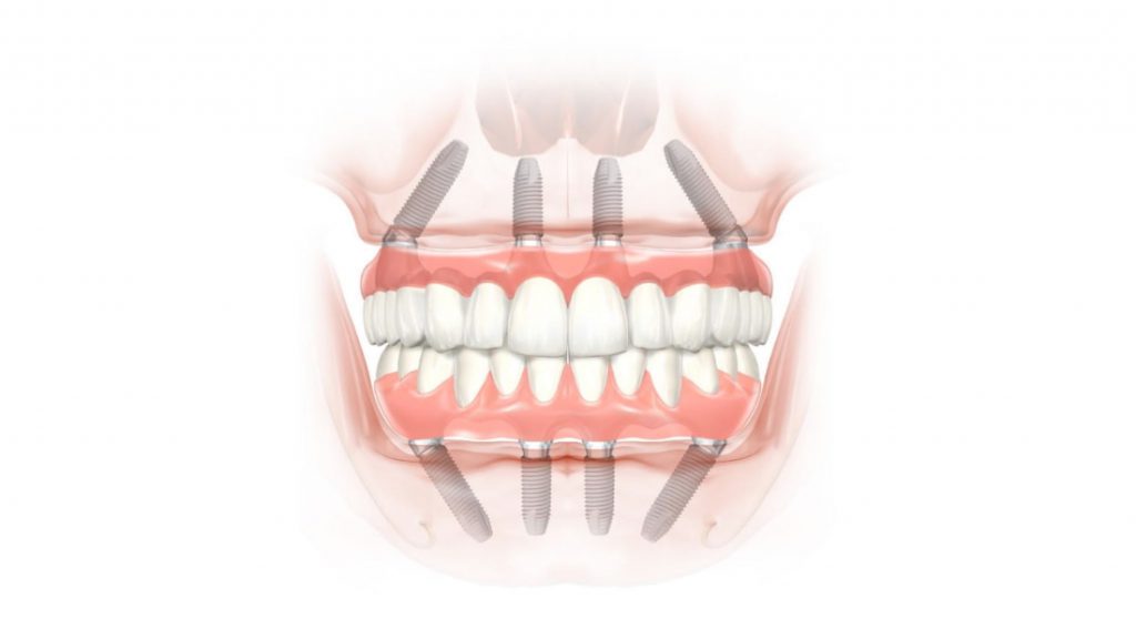 TUTTO SU 4 impianti dentali e un ponte fisso