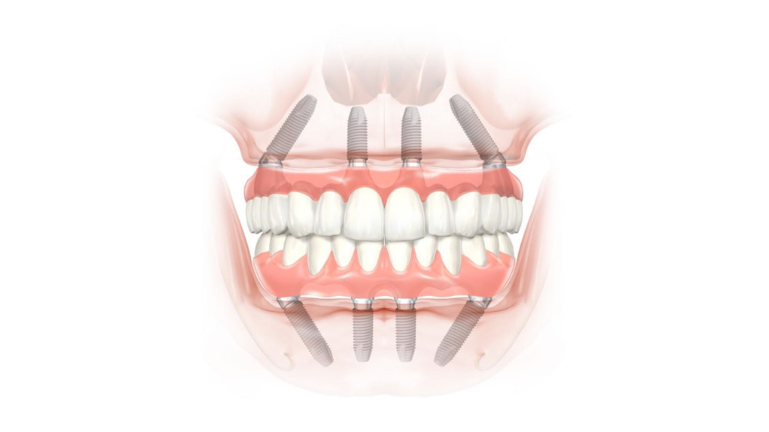 ALL ON 4 zubni implantati i fiksni most