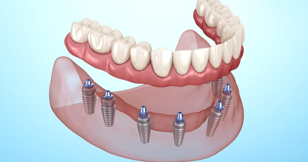 Misuratore Denti Medspo VDO Venus Apollo – Calibro Per Protesi Dentale E Pazienti Edentuli, Nuovo