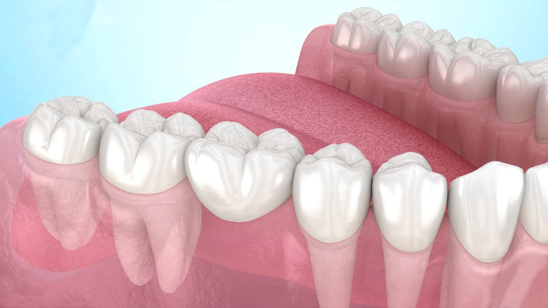 ALL ON 4 zubni implantati i fiksni most