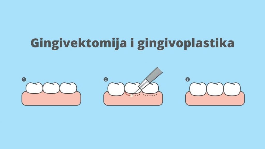 Gingivektomija i gingivoplastika