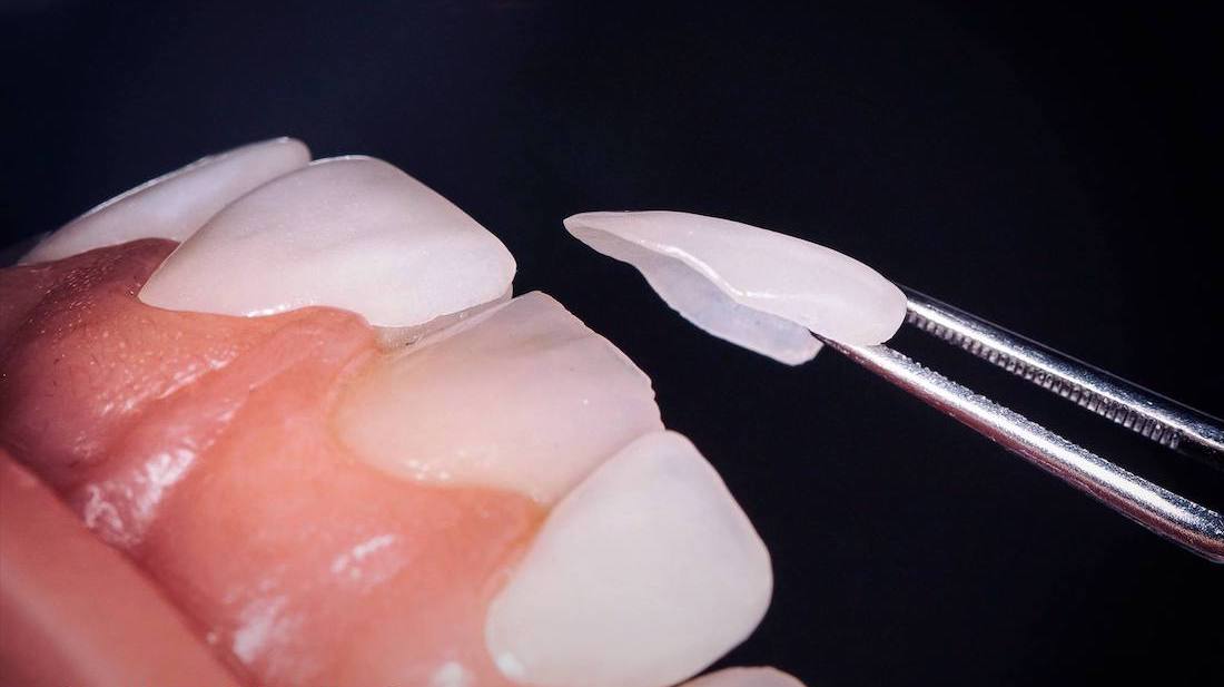 Faccette dentali - Ljuskice za zube