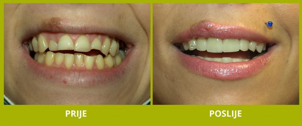 Primjer slučaja - ljuskice za zube