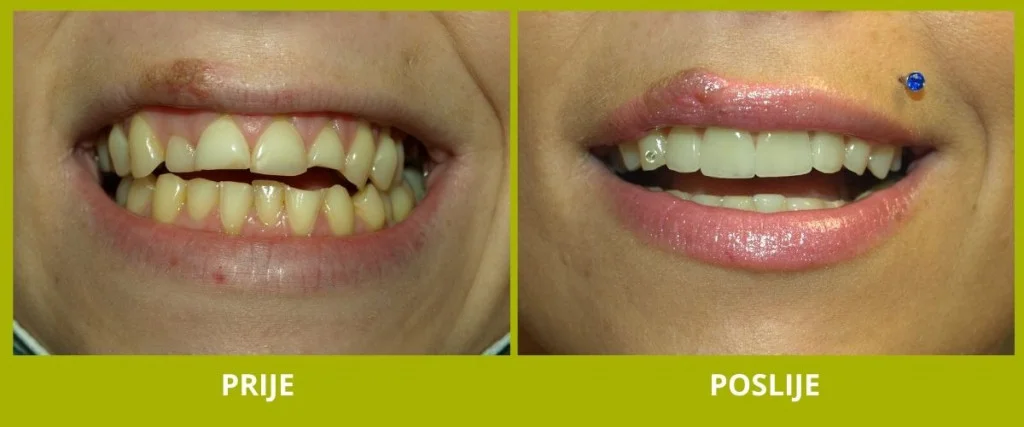 Primjer slučaja - ljuskice za zube