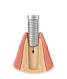 Zubni implantati Rijeka - postavljanje
