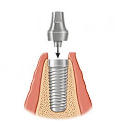 Zubni implantati Rijeka
