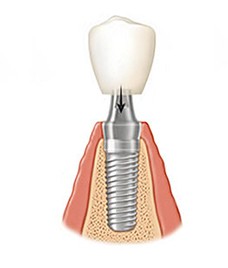Zubni implantati Rijeka