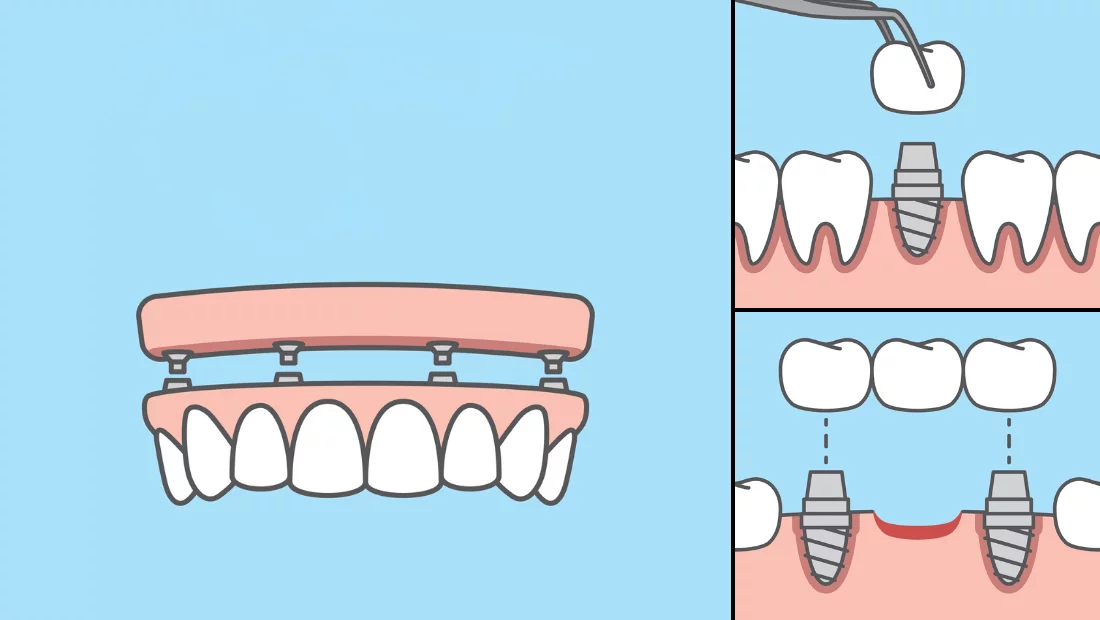 Zubni implantati