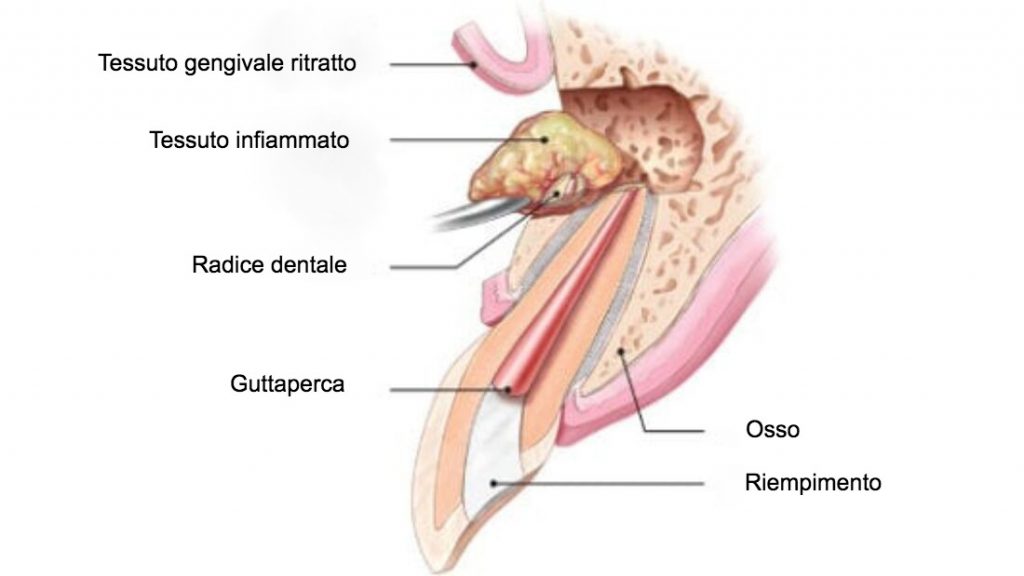 Apicectomia