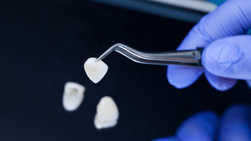 miti sulle faccette dentali