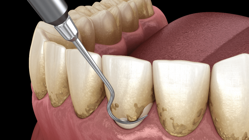 Curettage dentale curate le gengive infiammate Smile Studio