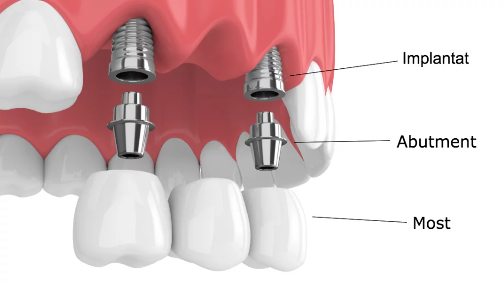 Implantati i implantoloski komplet