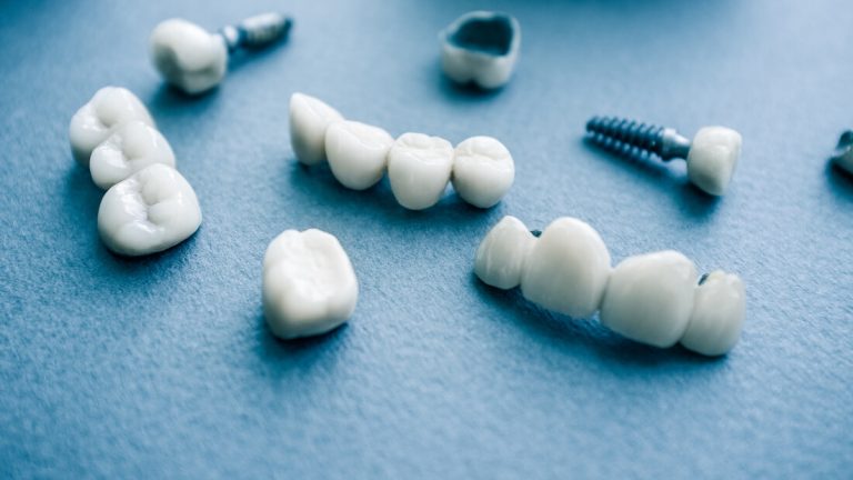 Razlika između zubnih implantata, krunica i mosta